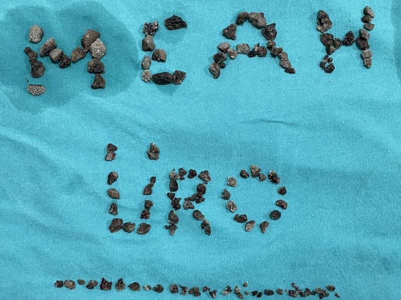 Malatya’da 8 Santimetrelik Böbrek Taşı Kapalı Yöntemle Alındı