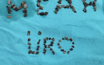 Malatya’da 8 Santimetrelik Böbrek Taşı Kapalı Yöntemle Alındı