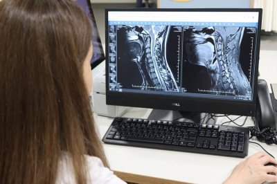 Uzmanından uyarı: Multiple Skleroz her hastada farklı seyrediyor