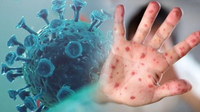 Maymun Çiçeği Virüsü: Riskler ve Korunma Yöntemleri